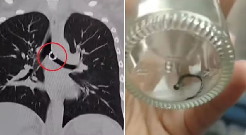 Após tosse crônica, mulher descobre piercing do nariz ‘perdido’ dentro do pulmão: ‘Terror’