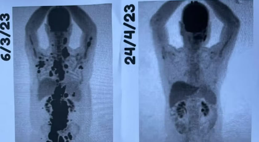 Paciente comemora remissão total do câncer após CAR-T Cell: 'Auge de uma luta de 13 anos'