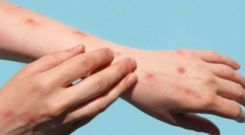 STF dá cinco dias para manifestação em ação sobre varíola dos macacos