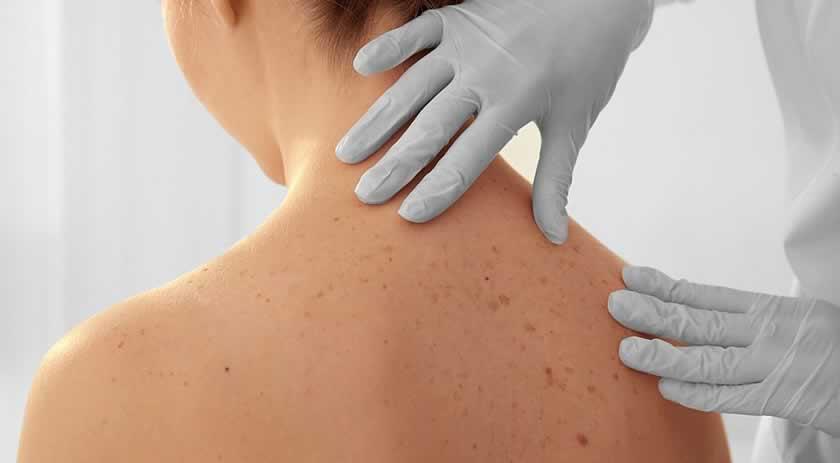 Câncer de Pele é o tipo mais comum de câncer no Brasil