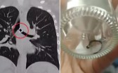 Após tosse crônica, mulher descobre piercing do nariz ‘perdido’ dentro do pulmão: ‘Terror’