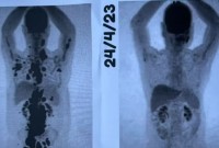 Paciente comemora remissão total do câncer após CAR-T Cell: 'Auge de uma luta de 13 anos'