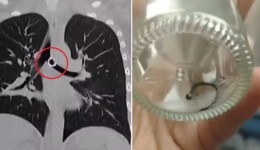 Após tosse crônica, mulher descobre piercing do nariz ‘perdido’ dentro do pulmão: ‘Terror’