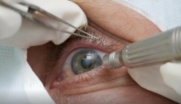 Lula faz cirurgia de catarata; entenda a doença e o procedimento