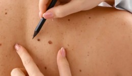 SC tem um dos maiores riscos de câncer de pele do Brasil, aponta Inca