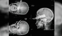 Mulher tem faca cravada no olho em tentativa de feminicídio no Oeste de SC