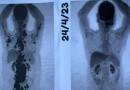 Paciente comemora remissão total do câncer após CAR-T Cell: 'Auge de uma luta de 13 anos'