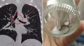 Após tosse crônica, mulher descobre piercing do nariz ‘perdido’ dentro do pulmão: ‘Terror’