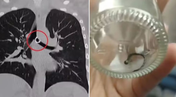 Após tosse crônica, mulher descobre piercing do nariz ‘perdido’ dentro do pulmão: ‘Terror’