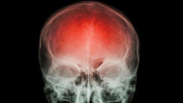 A cada 40 segundos, alguém sofre um AVC. Saber como reagir pode fazer a diferença
