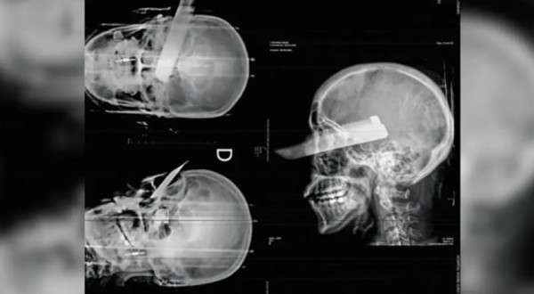 Mulher tem faca cravada no olho em tentativa de feminicídio no Oeste de SC