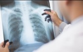 Anvisa aprova novo medicamento para tratamento de câncer de pulmão no Brasil